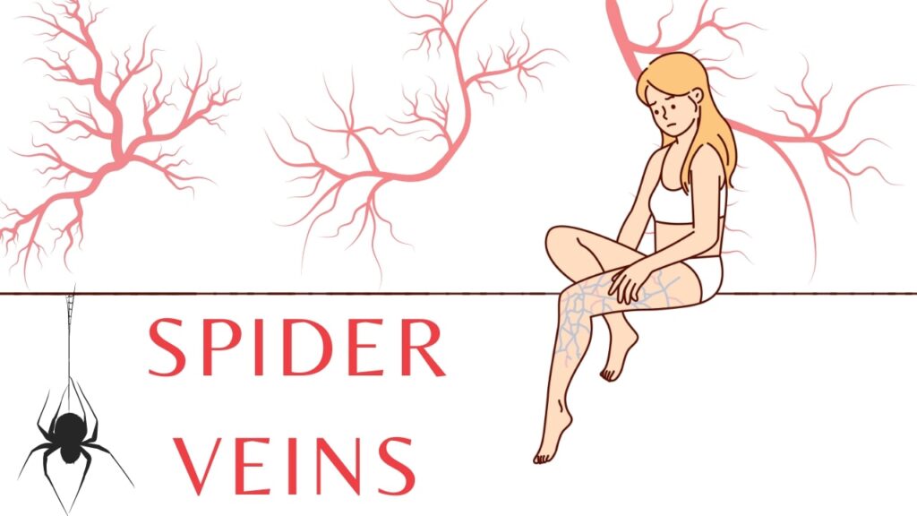 Rosacea and Spider Veins