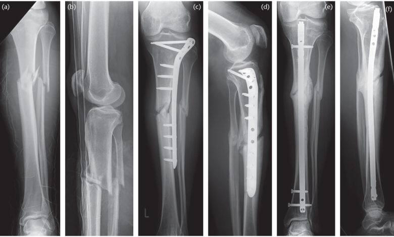 Understanding Non-Union Fractures - Causes, Symptoms, and Treatment