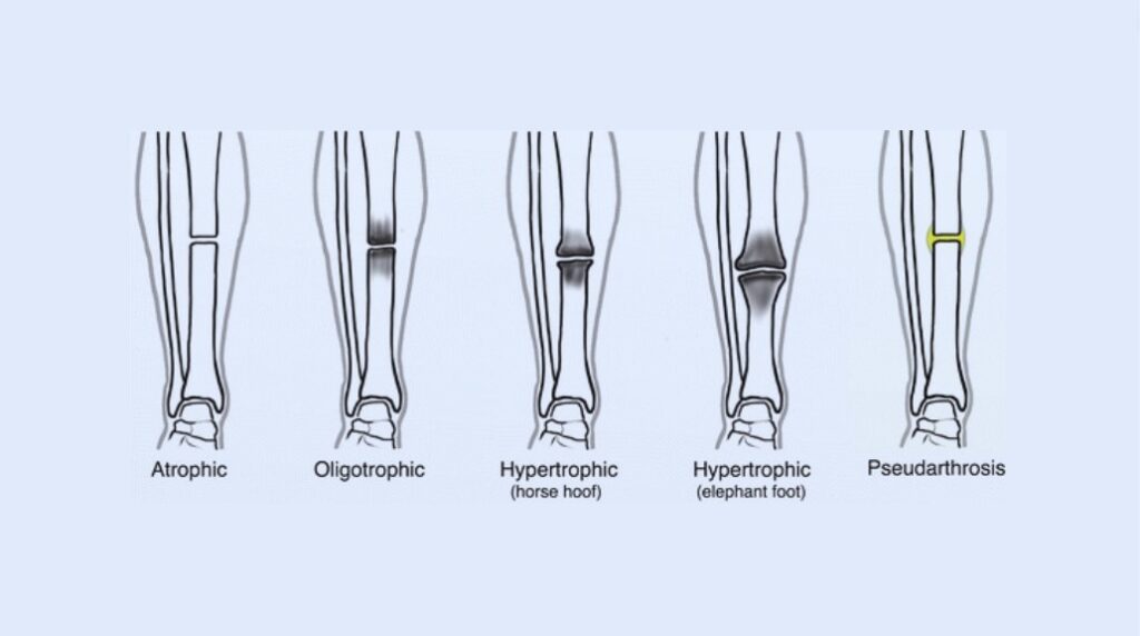 types of non-union fractures
