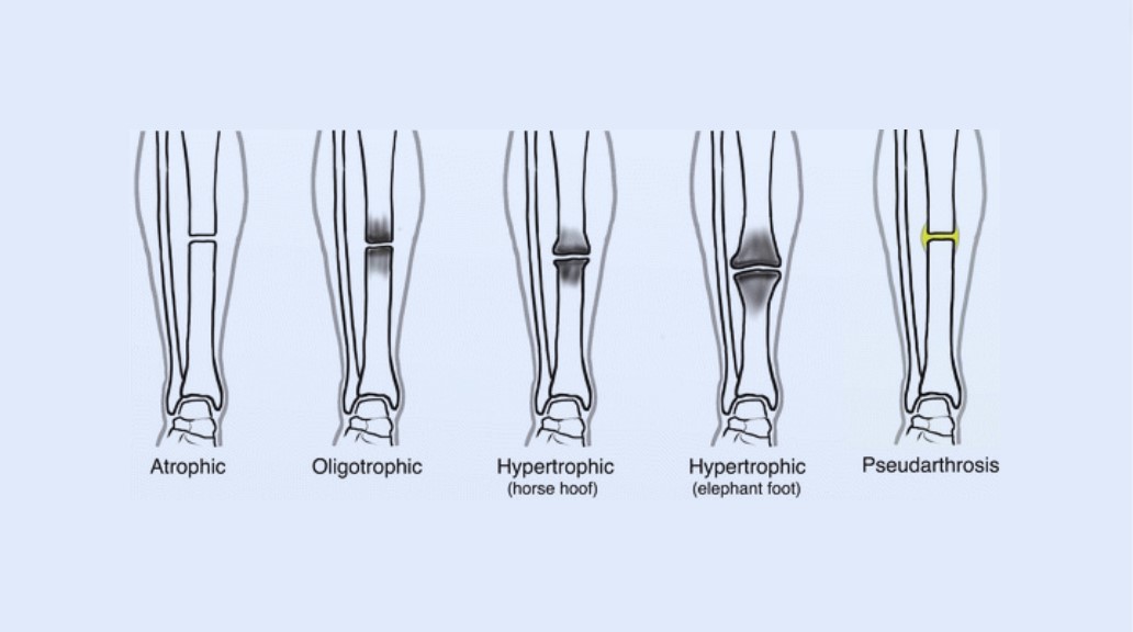 understanding-non-union-fractures-causes-symptoms-and-treatment