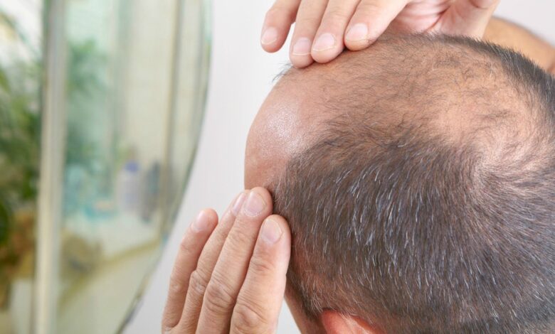 Battle the Bald: 3 Treatments for Men's Hair Loss